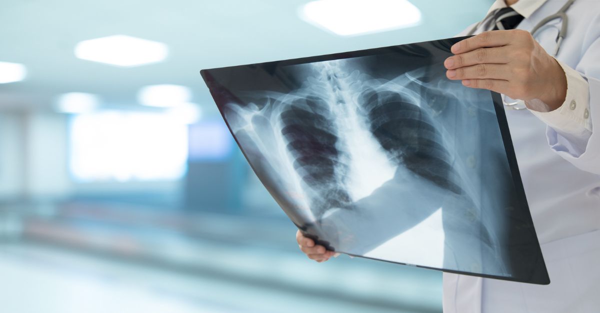 Doctor looking chest at x-ray image